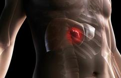 Cancer du foie : de nouveaux espoirs  grâce à la radiologie ?