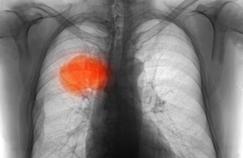 Des opérations non invasives contre le cancer du poumon