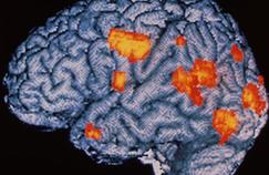 Schizophrénie : les prémices décelées par l'imagerie