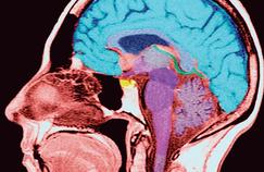 Schizophrénie : les troubles cognitifs seraient liés à l'inflammation cérébrale