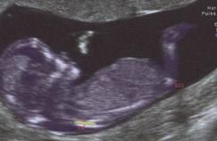 Trisomie 21 : vers la fin des amniocentèses ?
