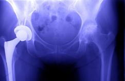 Les risques mesurés des prothèses de hanche en métal 