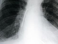 Défibrillateur cardiaque implantable (CDI)
