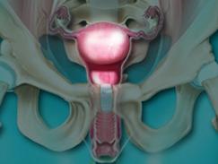 Dans certains cas, l'endométriose a un retentissement sur la fécondité