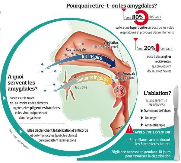 L'ablation des amygdales, une opération mieux ciblée