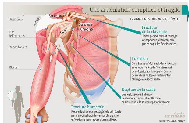 Contracture musculaire epaule droite