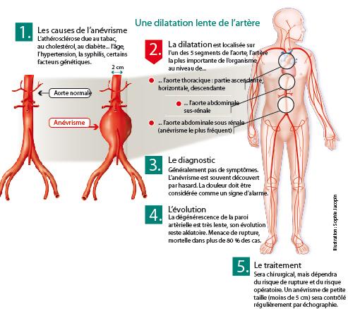 Anévrisme de l'aorte abdominale sous rénale - Qu’est ce que c’est ...