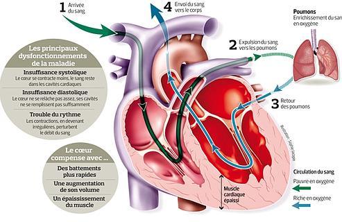 Este infográfico apresenta As formas de insuficiência cardíaca'insuffisance cardiaque