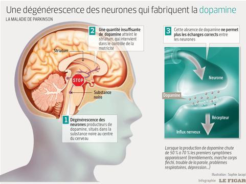 Maladie De Parkinson - Comment Cela Se Passe T Il ? - Fiches Santé Et ...