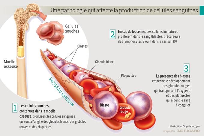 Leucemie Aigue Qu Est Ce Que C Est Fiches Sante Et Conseils Medicaux