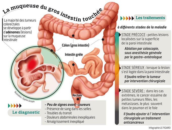Cancer Colique D finition Cancer Du C lon D finition Causes Et 