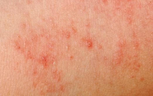 Eczéma - Qu’est-ce que l'eczema ? - Fiches santé et conseils médicaux