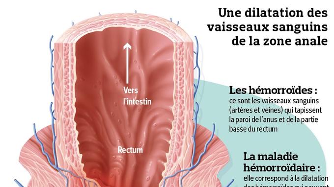 Hémorroïdes - Qu’est ce que c’est ? - Fiches santé et conseils médicaux