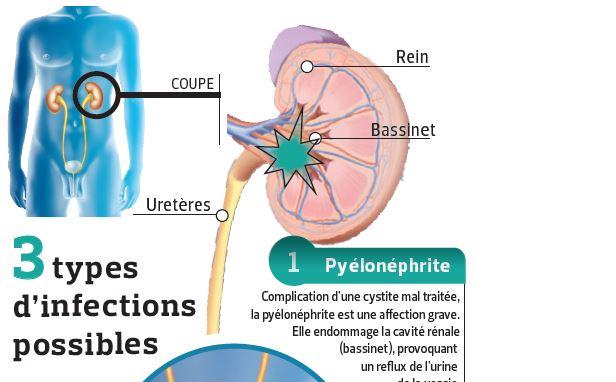 Cystite Infection Urinaire Quest Ce Que Cest Fiches Santé Et