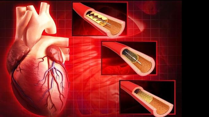 Des prothèses synthétiques pour réparer les artères