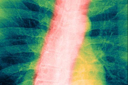 Radiografia polmonare di un fumatore con un polmonium cronico ostruttivo Pneumonio bronco-pneumonio.'un fumeur atteint de broncho-pneumopathie chronique obstructive.