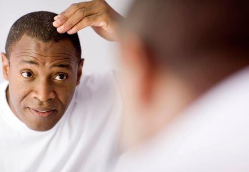 Calvitie homme lyon Clearance