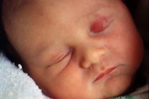 Hemangiome Infantile Une Lecon De Patience