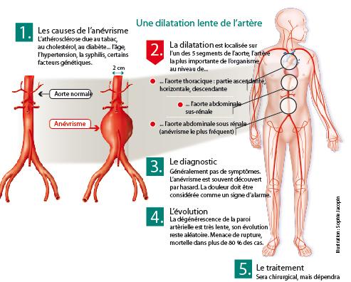 Hernie paroi abdominale síntomas de diabetes Hernie paroi abdominale síntomas de diabetes