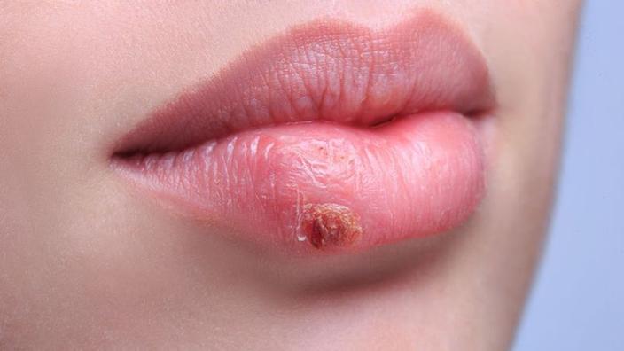 Les Nouvelles Pistes Therapeutiques Contre L Herpes Les Nouvelles Pistes Therapeutiques Contre L Herpes