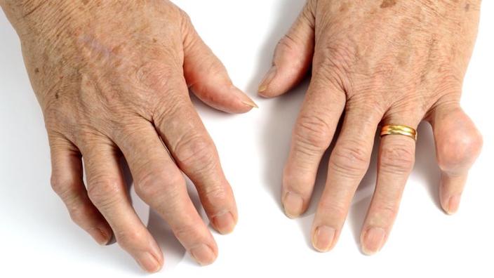 Des Traitements Efficaces Contre La Goutte