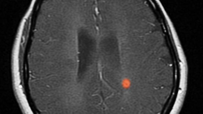 Ch T La Sclerose En Plaques