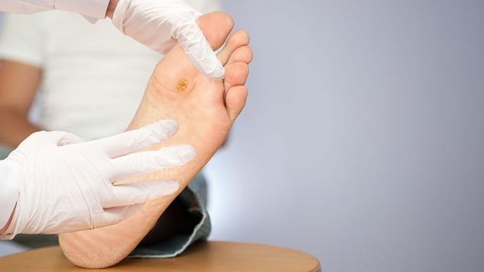 Verrues Comment Eviter La Contamination