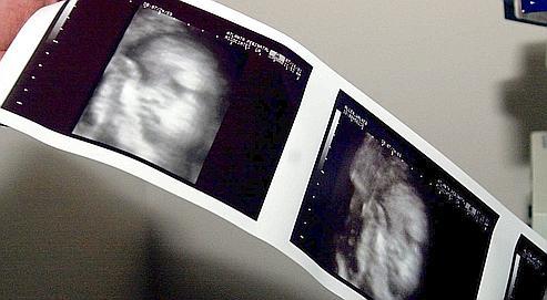 Malformations Fœtales Les Progres Du Depistage