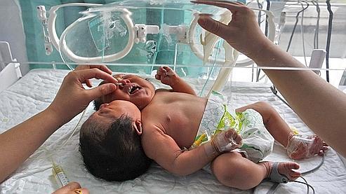 Un Bebe Chinois Nait Avec Deux Tetes