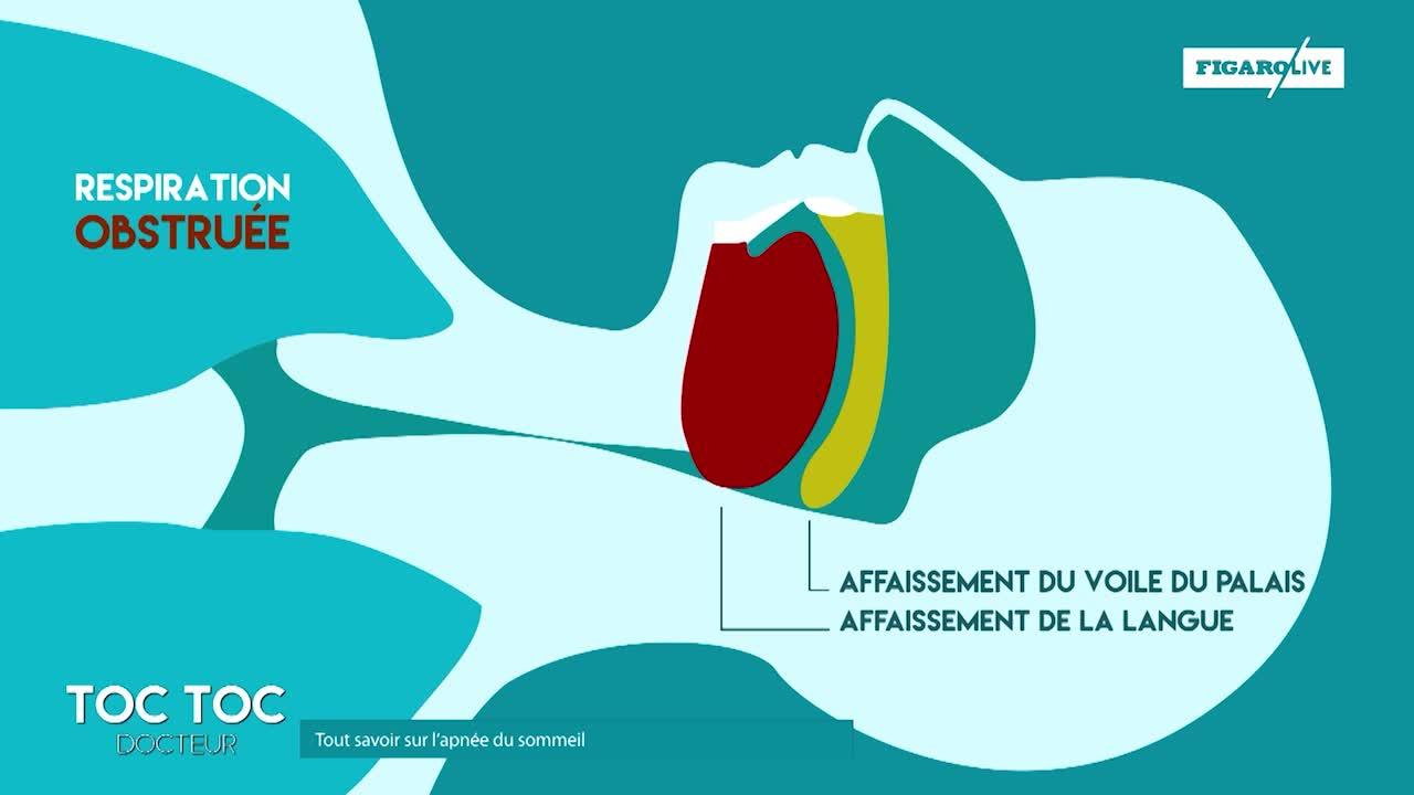 Qu’Est-Ce Que L’Apnée Du Sommeil – IXXLIQ