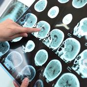 Alzheimer : un médicament expérimental diminue le déclin cognitif