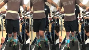 Des patients paralysés des deux jambes remarchent pour la première fois