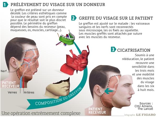 Greffes de visage, une médecine d'exception