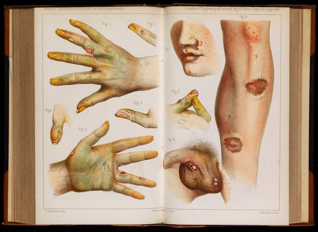 Des dommages physiques causés par l'usage d'arsenic vert, image datant de 1859.