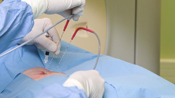 Cancérologie, cardiologie: détruire le mal par le froid