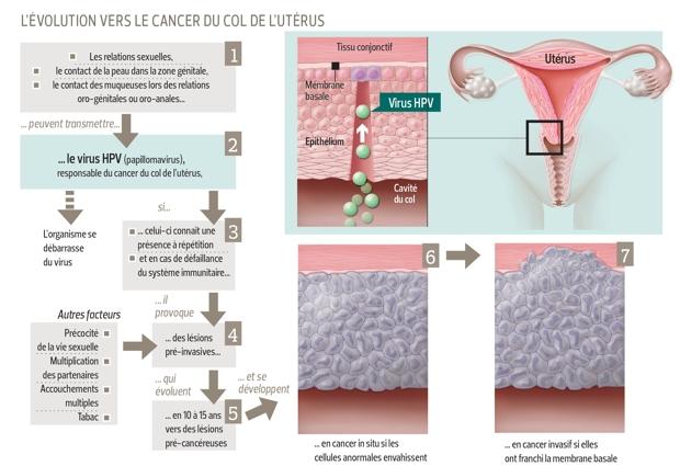 papillomavirus conisation recidive)