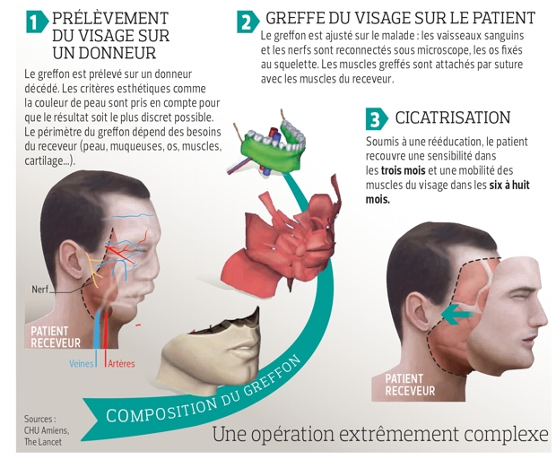 Greffe de visage le rejet était la plus grande crainte