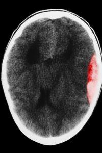 Scanner d'un hématome cérébral après un traumatisme crânien.