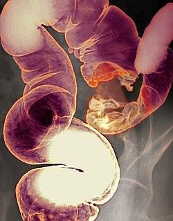 Habituellement peu répandue dans le tube digestif terminal, fusobacterium est présente en abondance dans certains cancers du côlon (ici, une radiographie de l'abdomen).