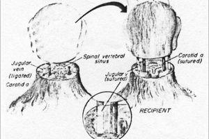 Dessin décrivant une greffe de tête chez le singe, telle que réalisée par le Dr White en 1970. (Crédit: White et al.)