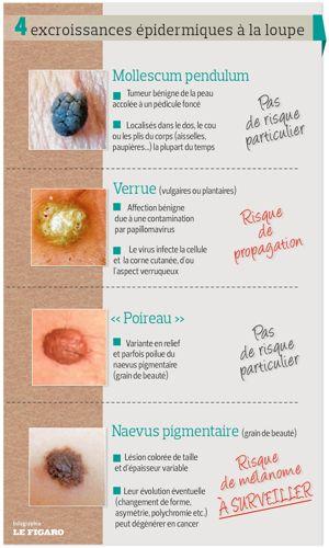 Bouton Sur Grain De Beauté : Causes, Soins et Conseils Essentiels