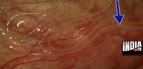 Le ver de 13 cm se situait sous la conjonctive, une membrane transparente qui tapisse l'intérieur de l'oeil et l'unit au globe oculaire. L'opération a été filmée. Capture extraite d'un reportage d'India TV.