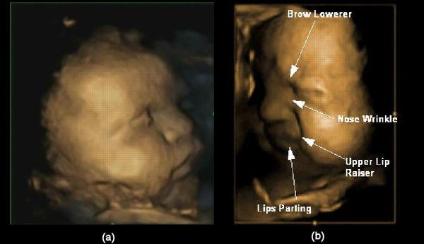 Mimiques typiques de foetus à 32 semaines de grossesse. L'image (a) montre un exemple de visage neutre et la (b) une expression de douleur, avec des combinaisons complexes de mouvements (abaissement des sourcils, froncements de nez, soulevèment de la lèvre supérieure et ouverture de la bouche). Crédit photo: Durham University