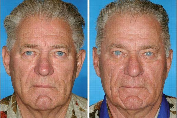 Le tabac acclre le vieillissement du visage Le tabac acclre le vieillissement du visage