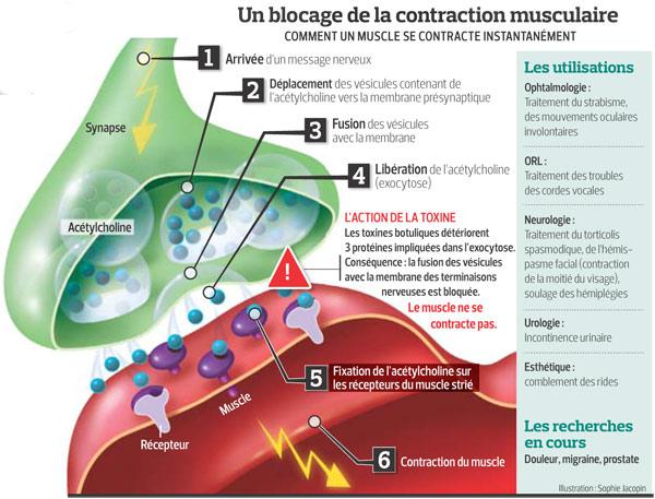 La Toxine Botulique Pourrait Soigner La Prostate