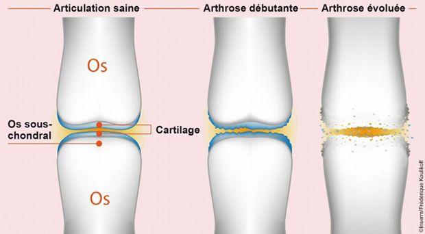 On parle d'arthrose lorsque la destruction du cartilage s'étend aux autres structures de l'articulation, notamment à l'os sous-chondral.