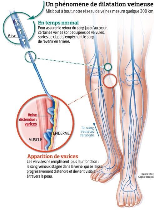 varice douloureuse jambe