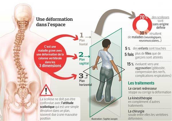 Il Faut Depister Les Scolioses Avant La Puberte