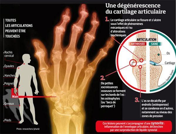 Arthrose Une Prise En Charge Insuffisante Selon Les Malades