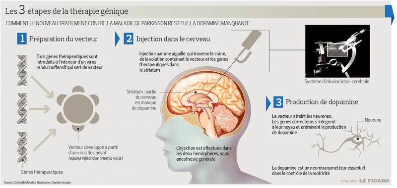 Parkinson : Résultats Prometteurs Pour La Thérapie Génique